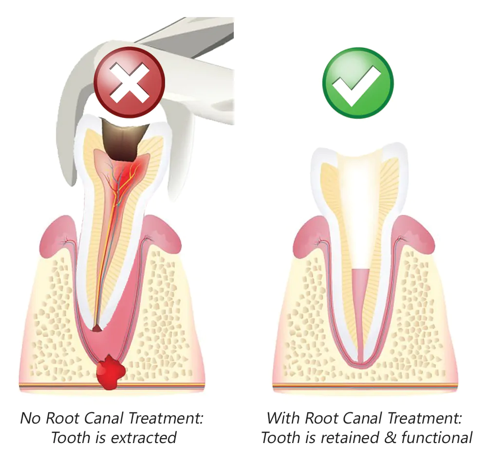 Root Canal Treatment